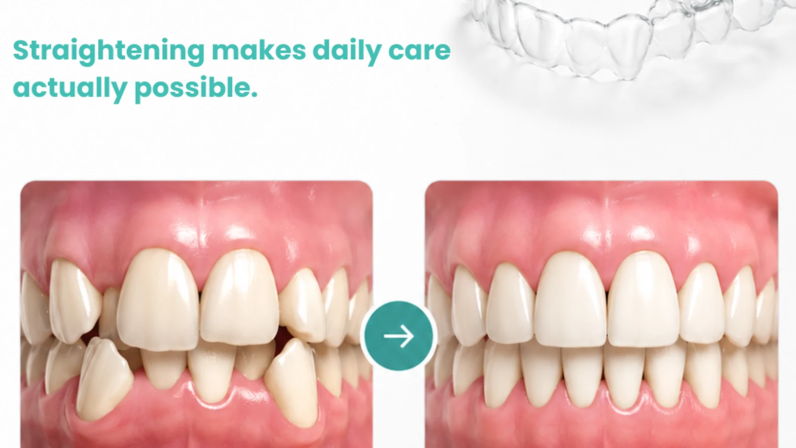Before and after teeth straightening transformation comparing crooked smile to aligned teeth with Invisalign clear aligners.